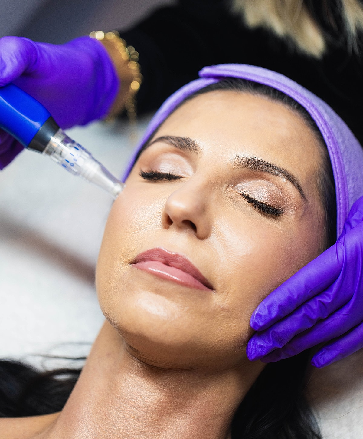 Facial treatment with microneedling device in progress.