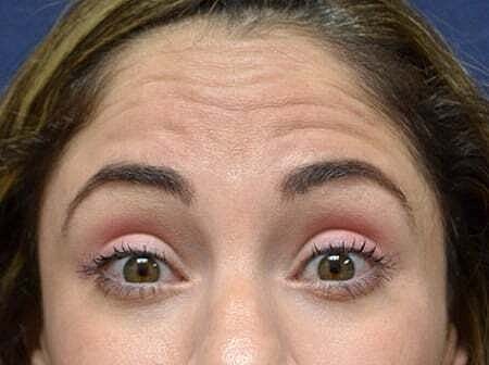 Botox Before & After