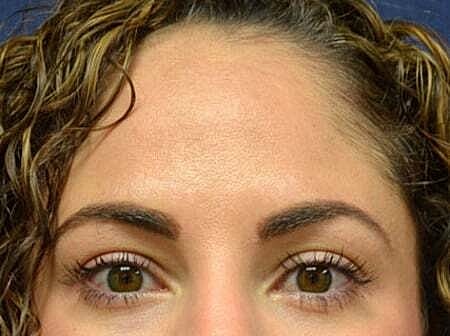 Botox Before & After
