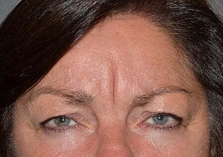 Botox Before & After