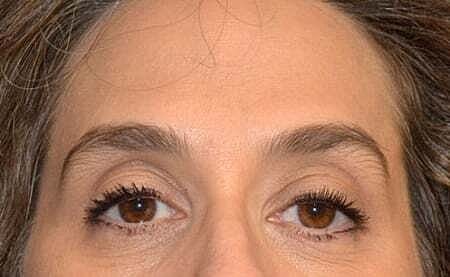 Botox Before & After