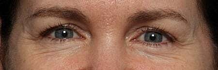 Botox Before & After