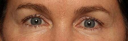 Botox Before & After