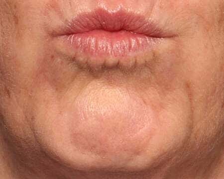 Botox Before & After