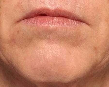 Botox Before & After