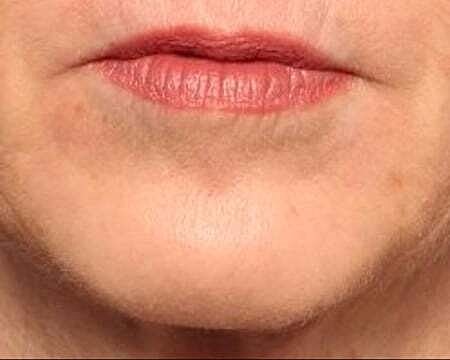 Botox Before & After