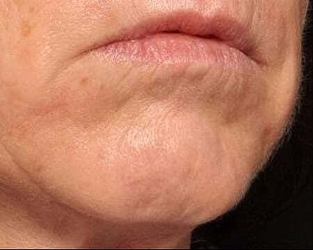 Botox Before & After