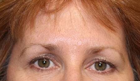 Botox Before & After