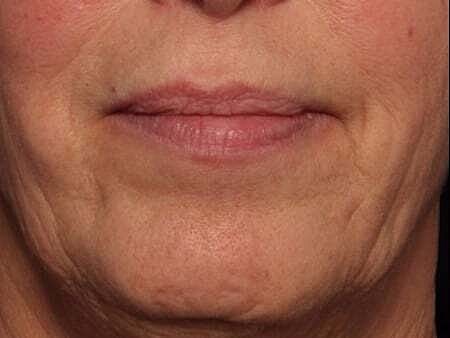 Botox Before & After