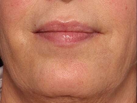 Botox Before & After