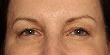 Botox Before & After