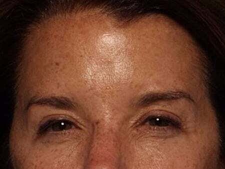 Botox Before & After