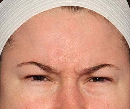 Botox Before & After