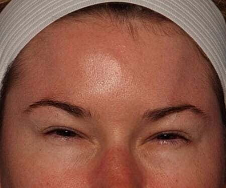 Botox Before & After