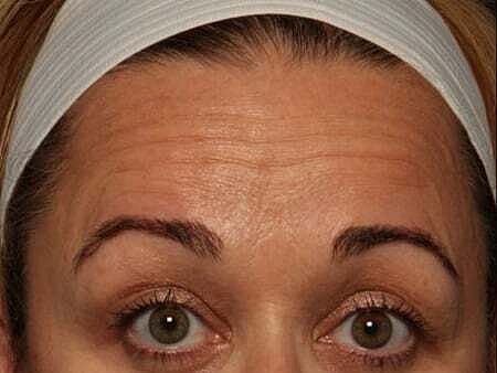 Botox Before & After