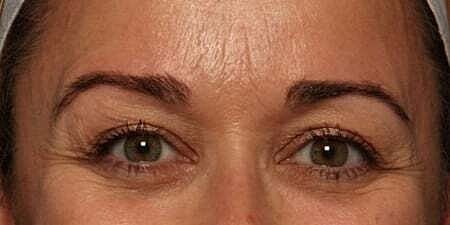 Botox Before & After