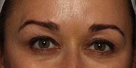 Botox Before & After