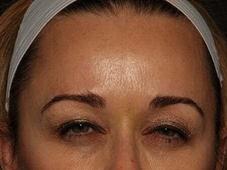Botox Before & After