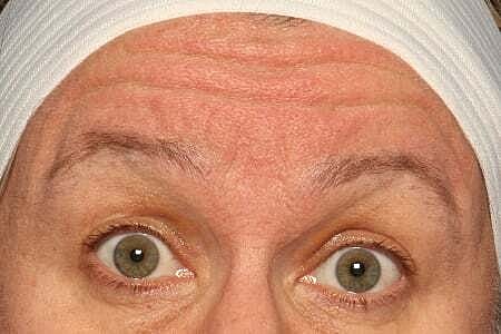Botox Before & After