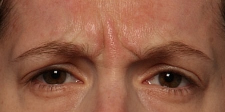 Botox Before & After