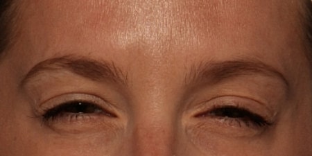 Botox Before & After