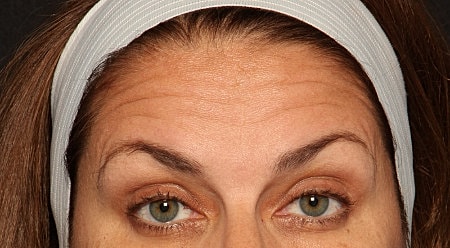 Botox Before & After