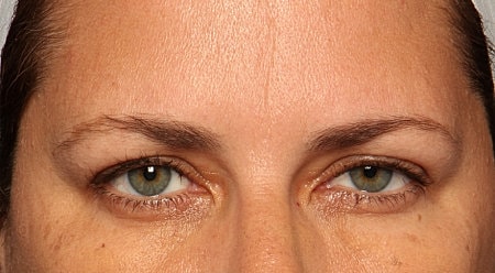 Botox Before & After