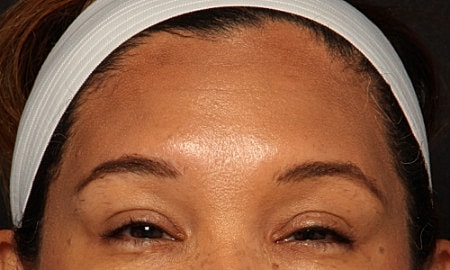 Botox Before & After