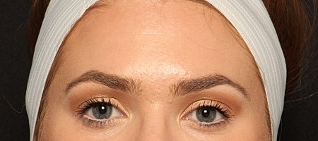 Botox Before & After