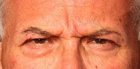 Botox Before & After