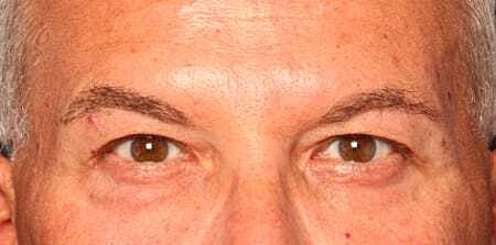 Botox Before & After