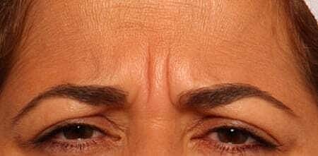 Botox Before & After