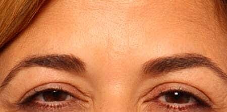 Botox Before & After