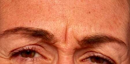 Botox Before & After