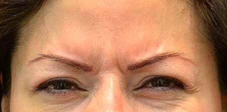 Botox Before & After