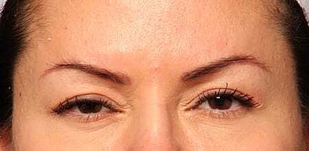 Botox Before & After