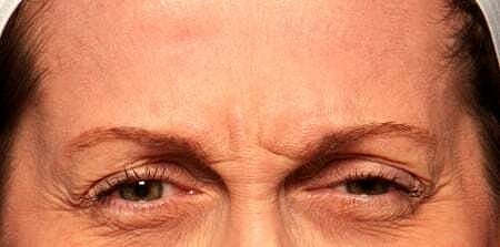Botox Before & After