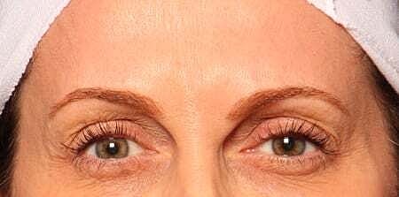 Botox Before & After