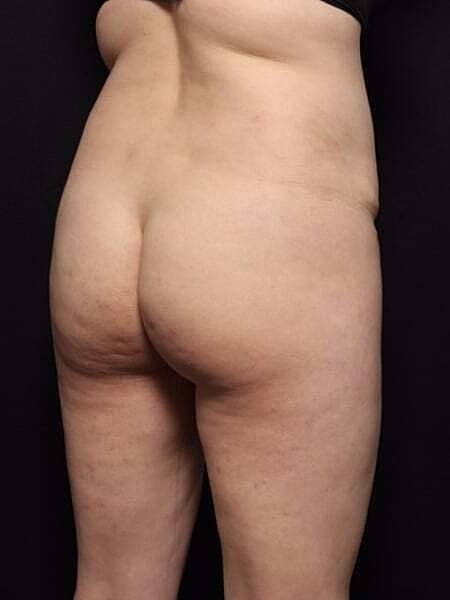 Buttock Lift Before & After