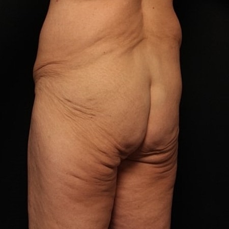 Buttock Lift Before & After