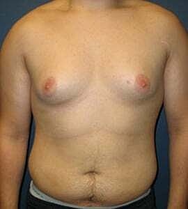 Gynecomastia Before & After