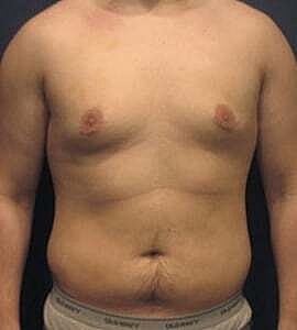 Gynecomastia Before & After