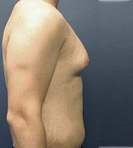 Gynecomastia Before & After