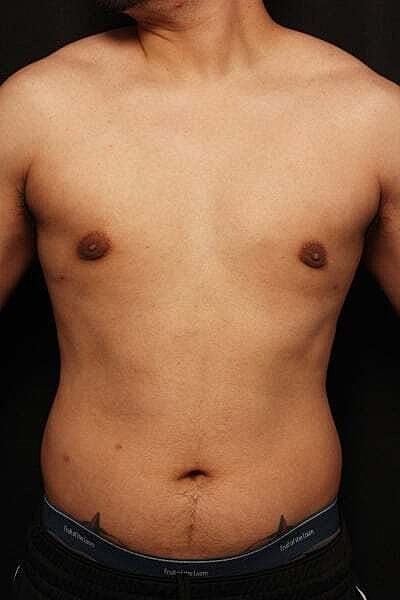 Gynecomastia Before & After
