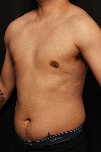 Gynecomastia Before & After