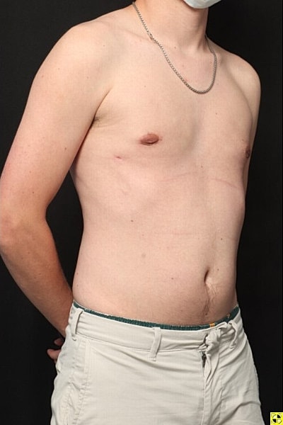 Gynecomastia Before & After