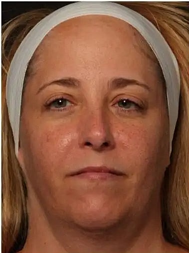 Before and After Kybella treatment for chin contouring