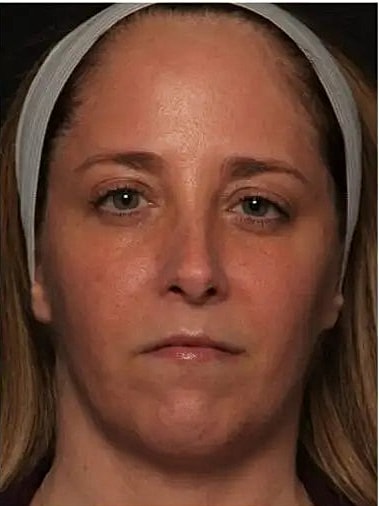 Before and After Kybella treatment for chin contouring