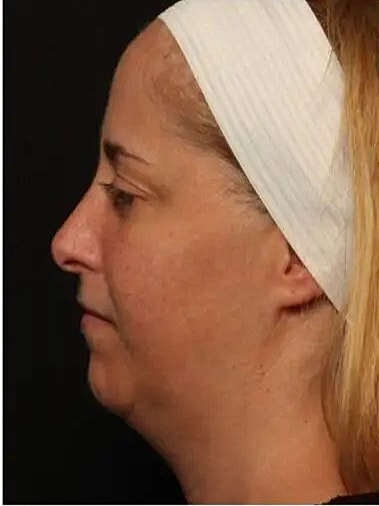 Before and After Kybella treatment for chin contouring