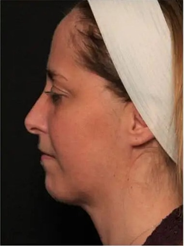 Before and After Kybella treatment for chin contouring